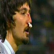TRABZON KALECİSİNİN BURNU 3 YERDEN BİRDEN KIRILDI!