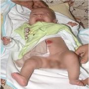 ÇİFT PİPİLİ, ÇİFT POPOLU BEBEK
