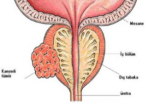 Prostat Kanseri Teşhisinde Yeni Dönem