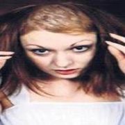 TEDAVİSİ OLMAYAN SAÇLARINI YOLMA HASTALIĞINA YAKALANDI