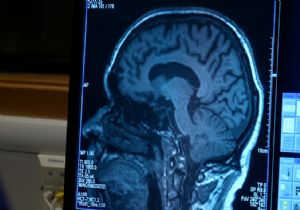 Alzheimer ı Yavaşlatan İlaca Onay