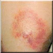 KIRIM KANGO,DOMUZ GRİBİ DERKEN ŞİMDİ DE LYME !