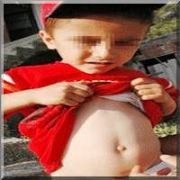 3 YAŞINDAKİ ÇOCUĞUN VÜCUDUNDAN 18 KENE ÇIKARTILDI!